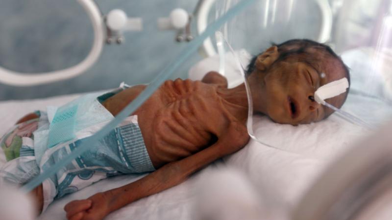 يواجه اليمن منذ وقت طويل اسوأ أزمة انسانية في العالم. 