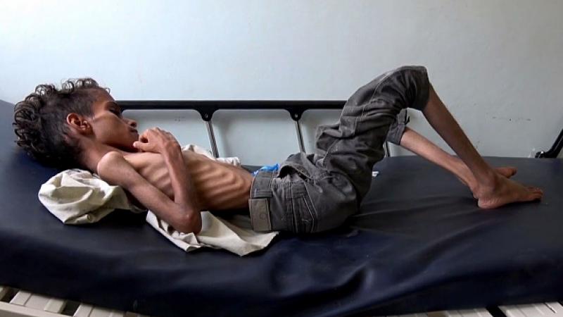 الأمم المتحدة: مئات الآلاف من أطفال اليمن مهددون بالموت جوعاً في 2021