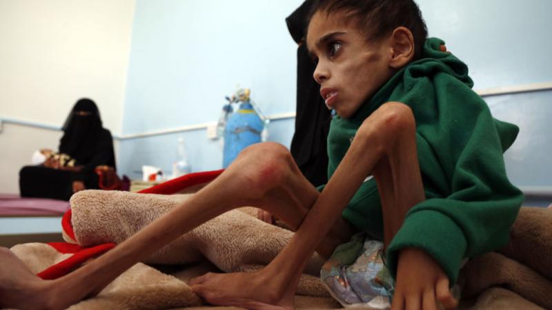 الجوع في اليمن