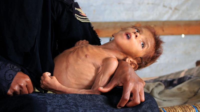 الجوع في اليمن